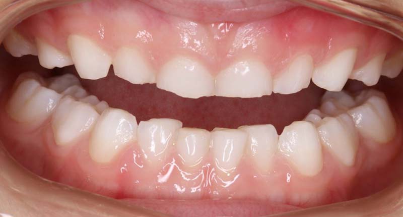 Прорезывание зубов или инфекционное заболевание